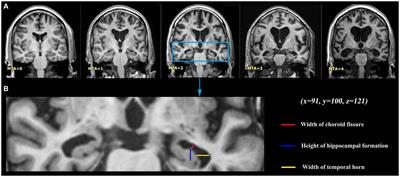 Executive function deficits and medial temporal lobe atrophy in late-life depression and Alzheimer’s disease: a comparative study